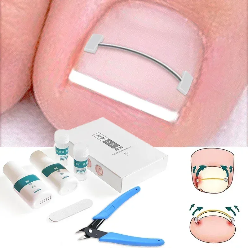 Correcteur d'ongles incarnés réglable, 4 fils
