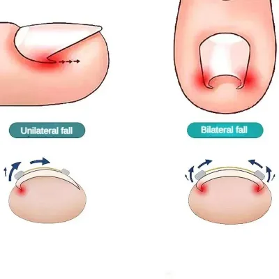 Correcteur d'ongles incarnés réglable, 4 fils – image 3